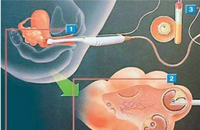 试管婴儿的几种精子选择法--备孕试管婴儿