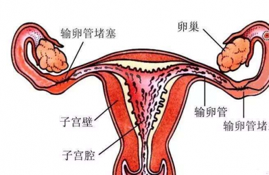 41岁输卵管堵塞可以直接做试管婴儿吗？-E试管-备孕试管不孕不育知识